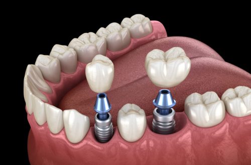 https://daycaresoft.com/2026/how-dental-implants-influence-your-digestive-health-and-nutritional-wellbeing.html