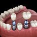 https://daycaresoft.com/2026/how-dental-implants-influence-your-digestive-health-and-nutritional-wellbeing.html