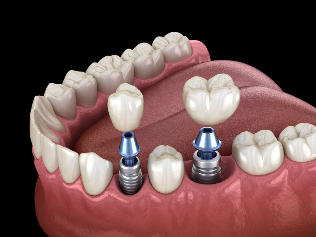 https://daycaresoft.com/2026/how-dental-implants-influence-your-digestive-health-and-nutritional-wellbeing.html